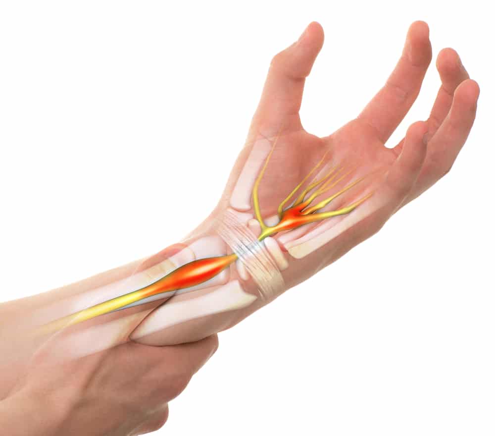 Carpal Tunnel Syndrome - Anatomy